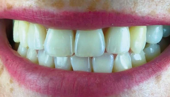 After - Montpelier Dental Care