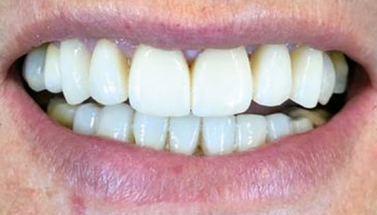 After - Montpelier Dental Care