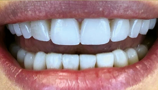 After - Montpelier Dental Care