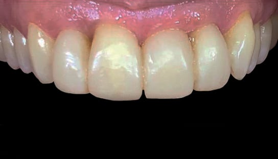 After - Montpelier Dental Care
