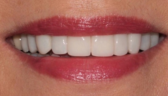 After - Montpelier Dental Care