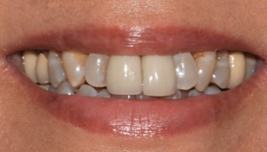 Before - Montpelier Dental Care
