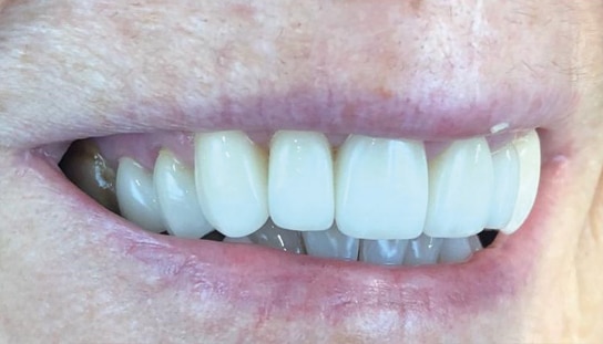 After - Montpelier Dental Care