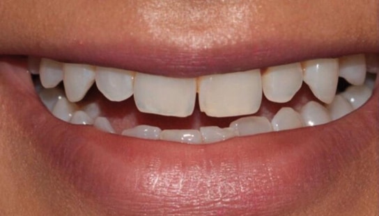 Before - Montpelier Dental Care
