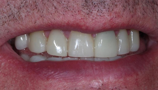 After - Montpelier Dental Care